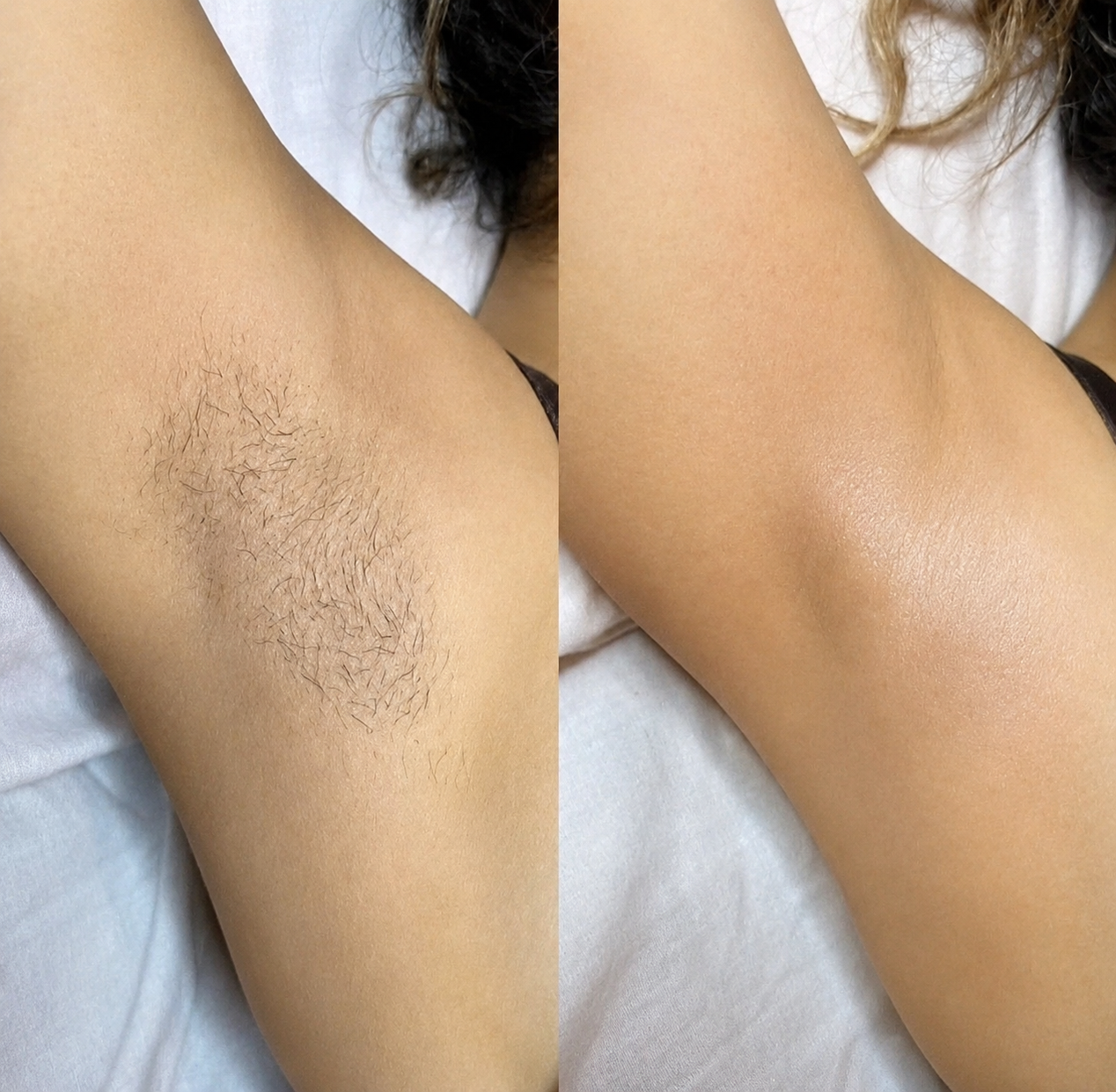 Épilateur Laser Permanent - Épilation Corps Et Zones Sensibles