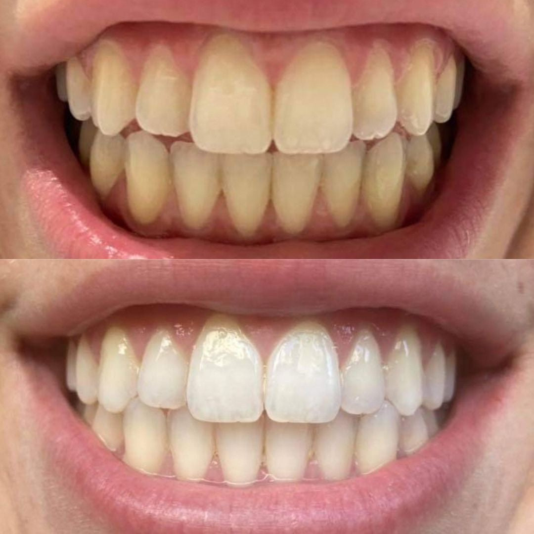 Bandes violettes blanchissantes pour les dents - éliminent les taches et diminue le jaunissement