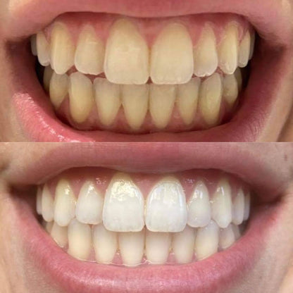 Bandes violettes blanchissantes pour les dents - éliminent les taches et diminue le jaunissement