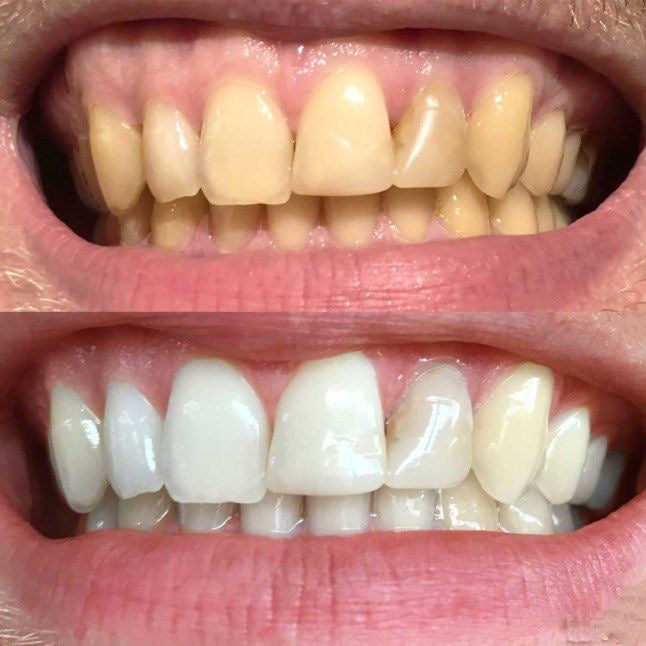 Bandes violettes blanchissantes pour les dents - éliminent les taches et diminue le jaunissement