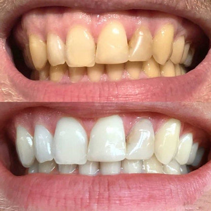 Bandes violettes blanchissantes pour les dents - éliminent les taches et diminue le jaunissement