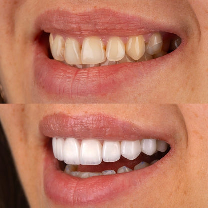 Bandes violettes blanchissantes pour les dents - éliminent les taches et diminue le jaunissement