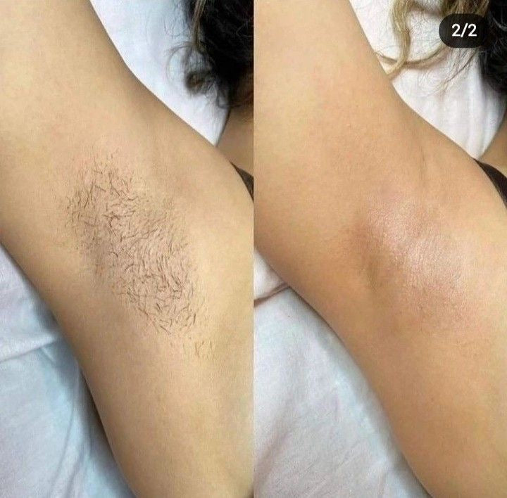Épilateur laser Permanent - Épilation corps et zones sensibles