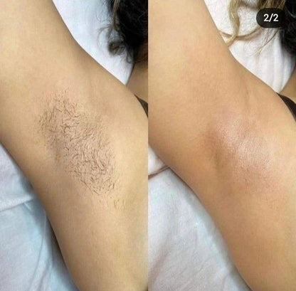 Épilateur laser Permanent - Épilation corps et zones sensibles