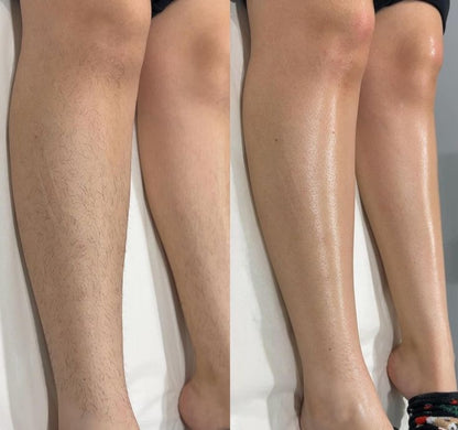 Épilateur laser Permanent - Épilation corps et zones sensibles