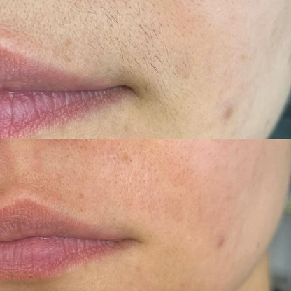 Épilateur laser Permanent - Épilation corps et zones sensibles